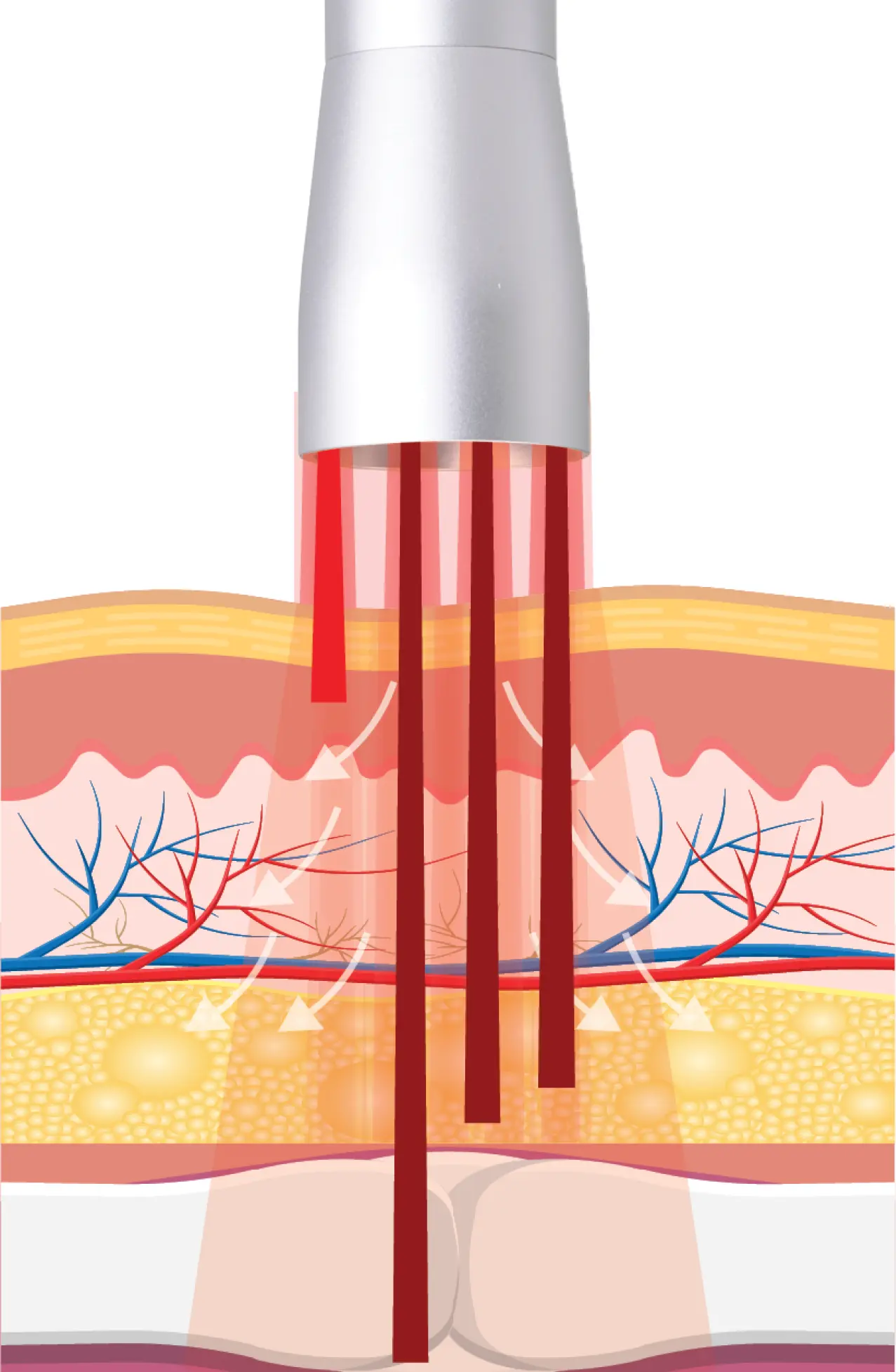 Laser infographic of the Summus light therapy