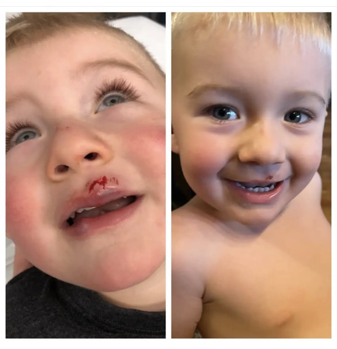 @summuslaser; instagram post; laser therapy before and after of young child with wound on his mouth